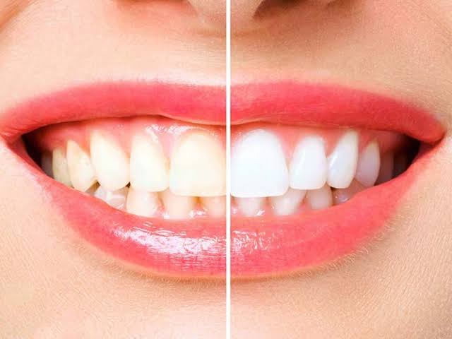 Natural Whitening At Home: How To Make Your Teeth Sparkle Like Pearls – TheNGblog