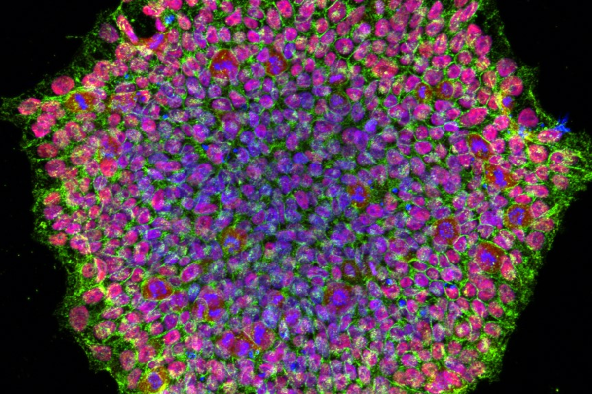 Reversing Type 1 Diabetes With A Patient’s Own Stem Cells